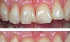 Fatetele dentare – PRO sau CONTRA