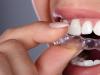 Bruxismul - cum iti sunt afectati dintii
