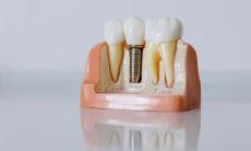 Dinti ficsi pe implanturi, reabilitarea completa pe care o puteti face. Ce presupune aceasta?