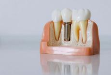 Dinti ficsi pe implanturi, reabilitarea completa pe care o puteti face. Ce presupune aceasta?