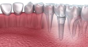  Implanturile Dentare din Zirconiu vs Implanturile din Titan