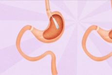 Inelul gastric, solutie impotriva obezitatii