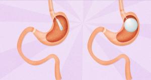 Inelul gastric, solutie impotriva obezitatii