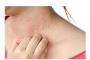 Pasi simpli pentru ingrijirea pielii afectate de psoriazis