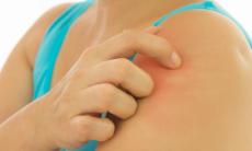 Remedii eficiente pentru ameliorarea intepaturilor de tantari