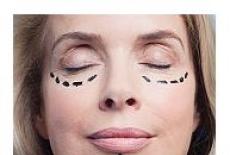 Liftingul facial (ritidectomie)