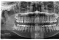 Implicatiile molarului de minte asupra sanatatii orale