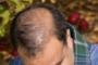 Transplantul de par (graftingul) si reducerea scalpului