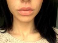 Marire buze cu acid hialuronic Princess Bucuresti